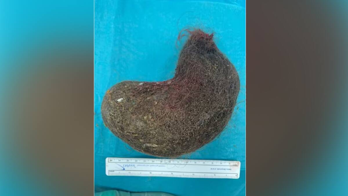 Surgeons remove 30cm-long hairball from stomach of teen with hair-eating disorder
