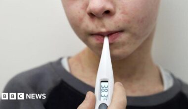 A young boy with a measles rash on his face and neck takes his temperature using a digital thermometer. He wears a black and grey sweatshirt over a white t-shirt.