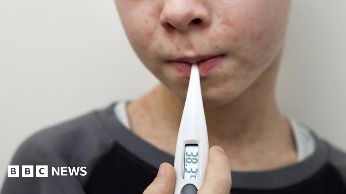 A young boy with a measles rash on his face and neck takes his temperature using a digital thermometer. He wears a black and grey sweatshirt over a white t-shirt.