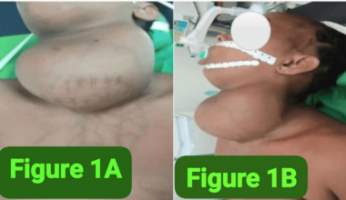 Emergency Total Thyroidectomy for Giant Papillary Thyroid Carcinoma Presenting With Acute Airway Obstruction: Management in the Setting of Thyrotoxicosis