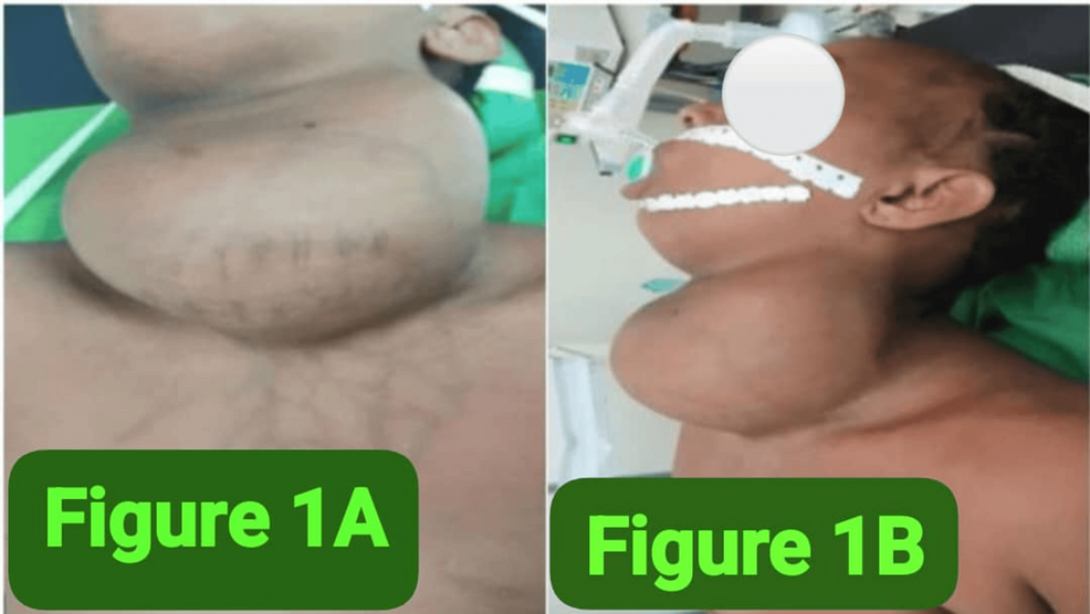 Emergency Total Thyroidectomy for Giant Papillary Thyroid Carcinoma Presenting With Acute Airway Obstruction: Management in the Setting of Thyrotoxicosis