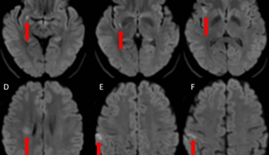Spontaneous Unruptured Middle Cerebral Artery Dissection Presenting With Ischemia: Conservative Management and Rescue Endovascular Intervention
