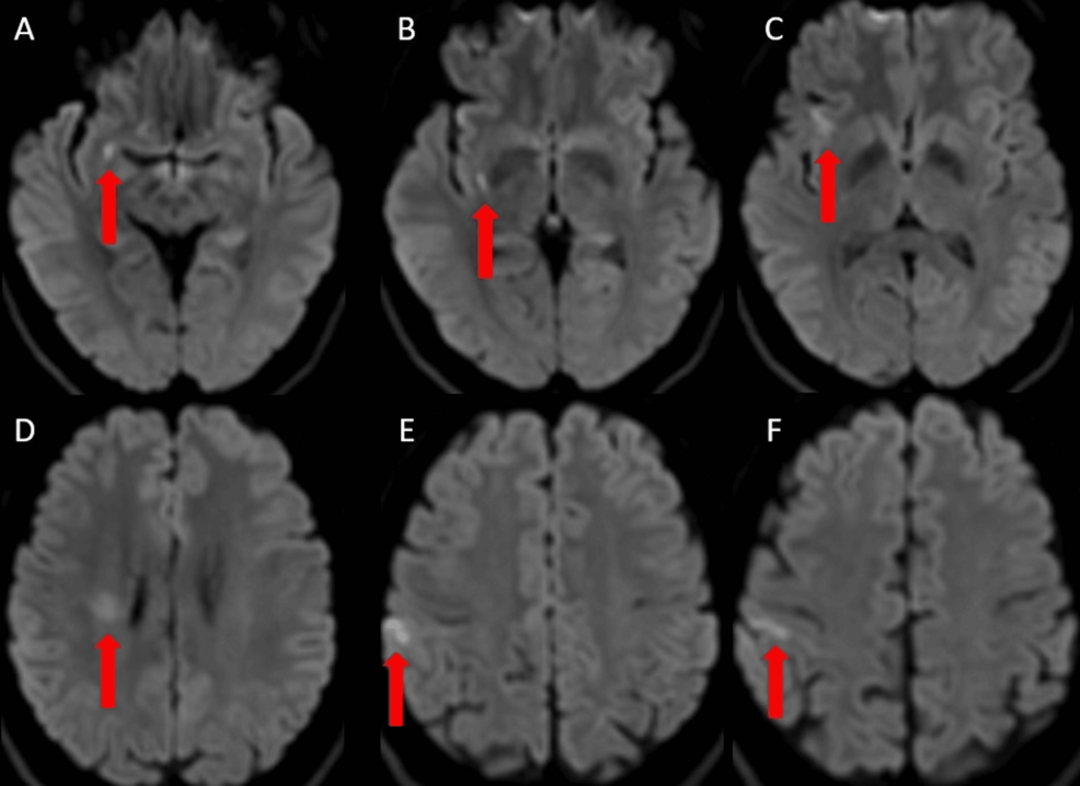 Spontaneous Unruptured Middle Cerebral Artery Dissection Presenting With Ischemia: Conservative Management and Rescue Endovascular Intervention
