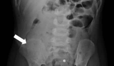 Navigating the Diagnostic Dilemma: Cecal Duplication Cyst and Intussusception in Pediatric Patients
