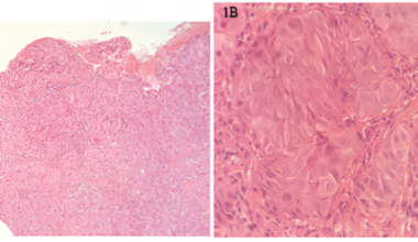 Cracking the Chameleon: Uncommon Presentations and Pitfalls of Oral Squamous Cell Carcinoma