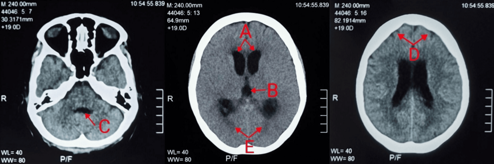 Listeria monocytogenes Meningitis With Hydrocephalus in a Patient With Sjögren’s Syndrome and Penicillin Allergy