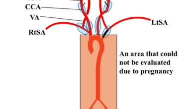 Regional Cerebral Oxygen Saturation Monitoring in an Emergency Cesarean Section for Takayasu Arteritis: A Case Report on Utility and Limitations