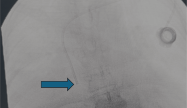 Unexpected Internal Mammary Vein Cannulation by an Implantable Central Venous Catheter: A Rare Complication