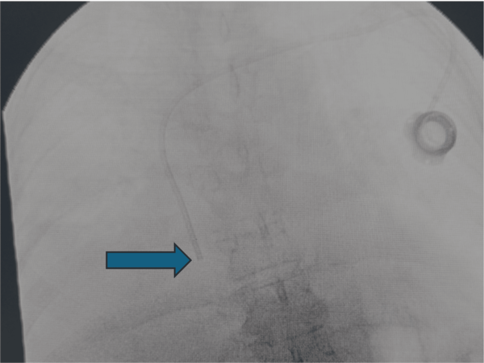 Unexpected Internal Mammary Vein Cannulation by an Implantable Central Venous Catheter: A Rare Complication