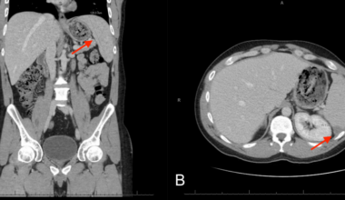 Pulmonary Nodules and Splenic Lesions as Rare Extraintestinal Manifestations of Crohn’s Disease