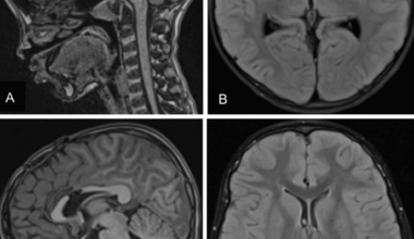 Incidentally Detected Colloid Cyst in a Pediatric Patient With Facio-Audio-Symphalangism Syndrome: A Case Report