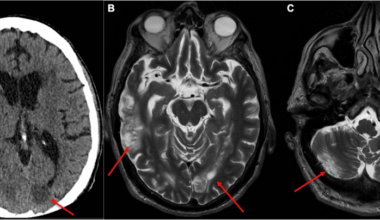 Infective Endocarditis With Negative Cardiac Multimodal Imaging: A Case Report