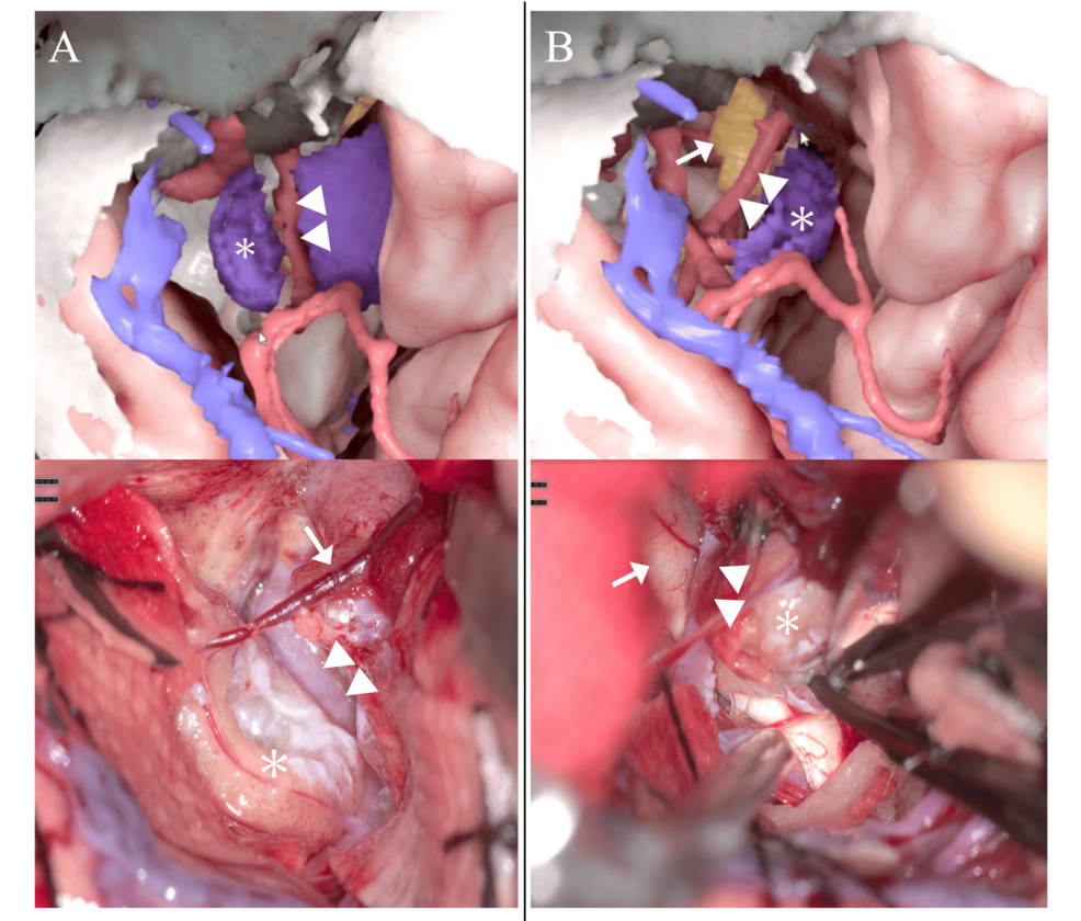 A Comprehensive Three-Dimensional Simulation Method for Skull Base Meningioma Surgery