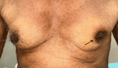 Male Breast Carcinoma in an Elderly Patient: A Rare Presentation and the Importance of Individualized Management