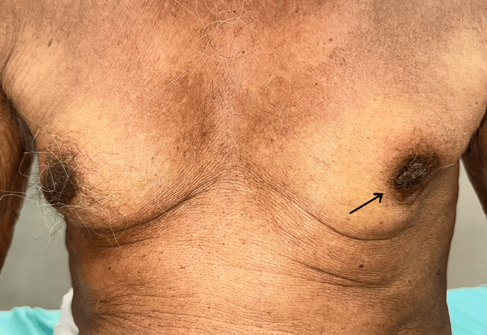 Male Breast Carcinoma in an Elderly Patient: A Rare Presentation and the Importance of Individualized Management