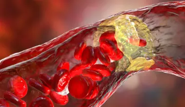 Powerful cholesterol drug cuts heart attack risk by 31%