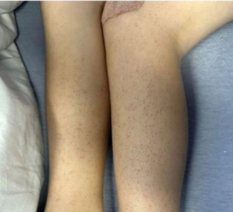 5-year-old found with scurvy | Otago Daily Times Online News