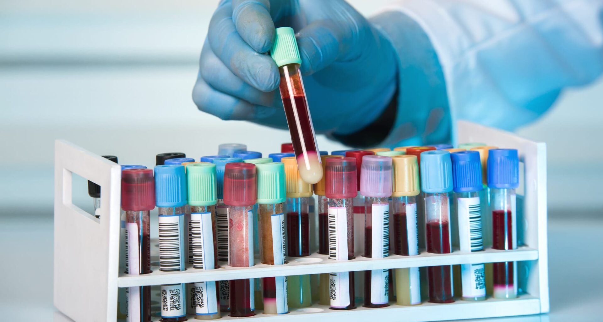 Test Identifies Active, Infectious Tuberculosis