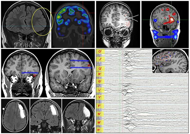 multi-panel figure with 10 brain scans and EEG tracings