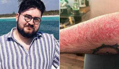 Man Recalls 'Emotional Toll' of Having Psoriasis as a Teen: 'It Was Very Difficult to Live and Be Out in the World' (Exclusive)