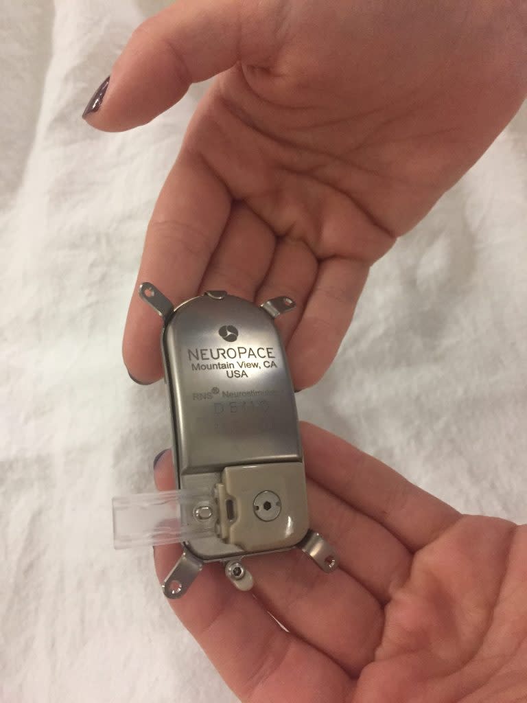 The NeuroPace implant used to stop Hoffman’s seizures. Courtesy of Arielle Hoffman