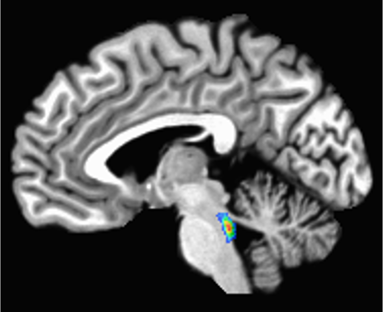 A scan of the brain with the locus coeruleus lit up in the brain stem