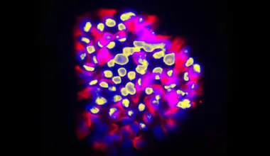 New AI tool predicts cancer spread with surprising accuracy