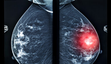 X-ray mlo mammography for breast cancer, checking breasts. X-ray image of the breast in women, breast scan. Red area shows pain.