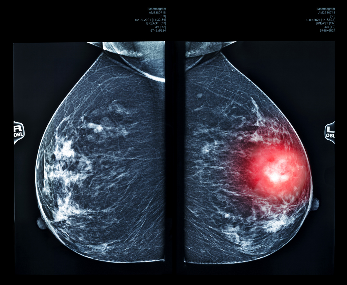 X-ray mlo mammography for breast cancer, checking breasts. X-ray image of the breast in women, breast scan. Red area shows pain.