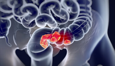 Colorectal cancer,medical anatomical illustration.3d illustrationColorectal cancer,medical anatomical illustration.3d illustration