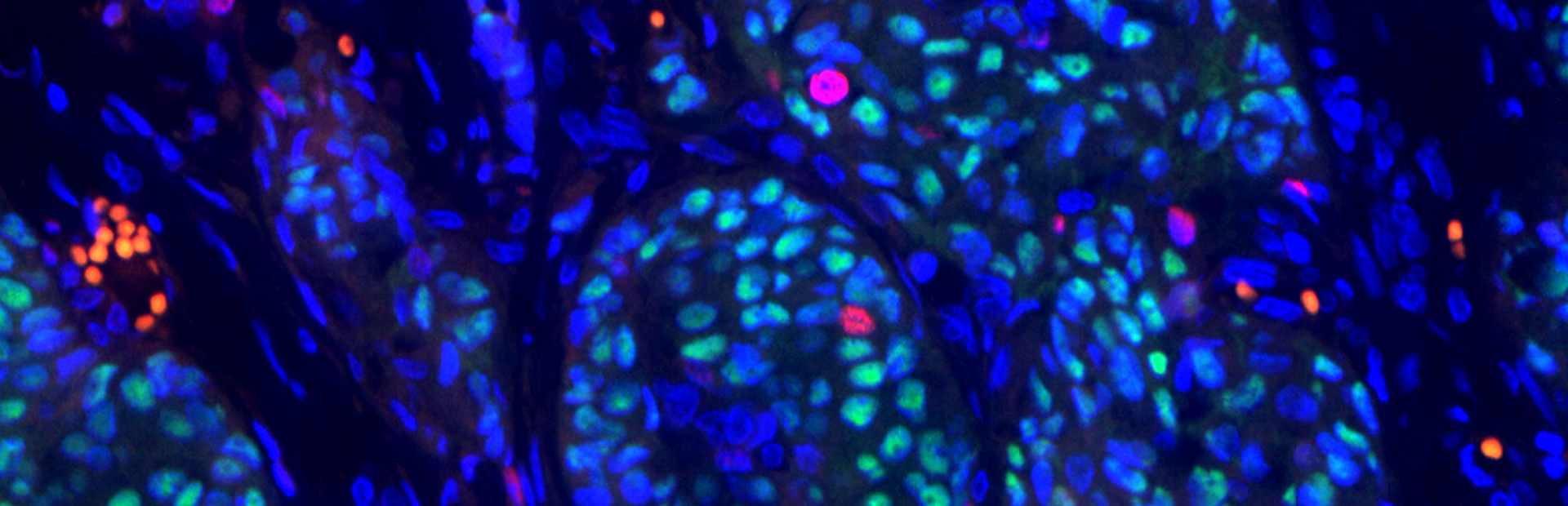 Bringing proteins together to take cancer apart