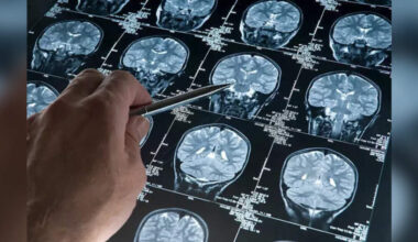 Study Links Parkinson's Protein to Accelerated Alzheimer's in Women, ETHealthworld