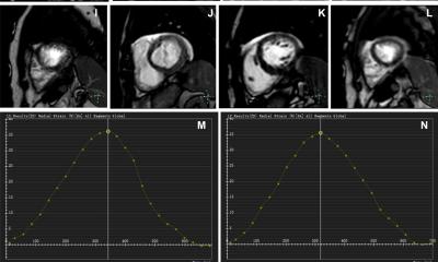 AI-enhanced MRI enables single-shot imaging of cardiac cycle • healthcare-in-europe.com