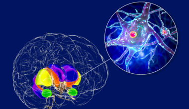 Blocking protein pathway may slow Huntington’s disease