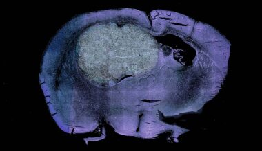 Fred Hutch collaboration reveals molecular vulnerability in rare childhood brain cancer