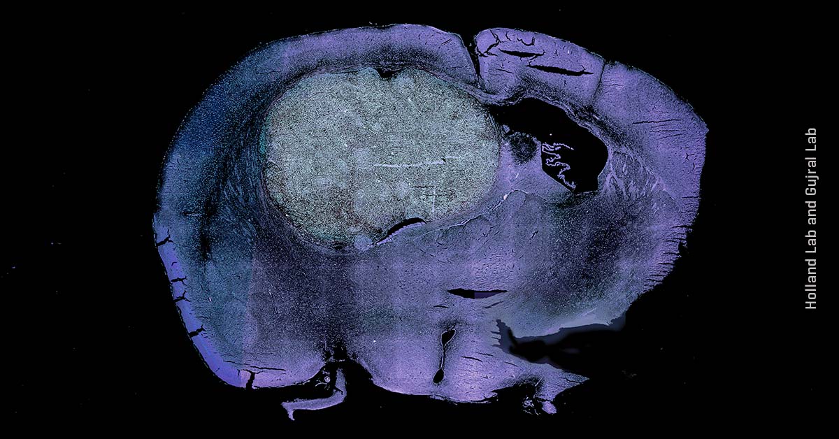 Fred Hutch collaboration reveals molecular vulnerability in rare childhood brain cancer