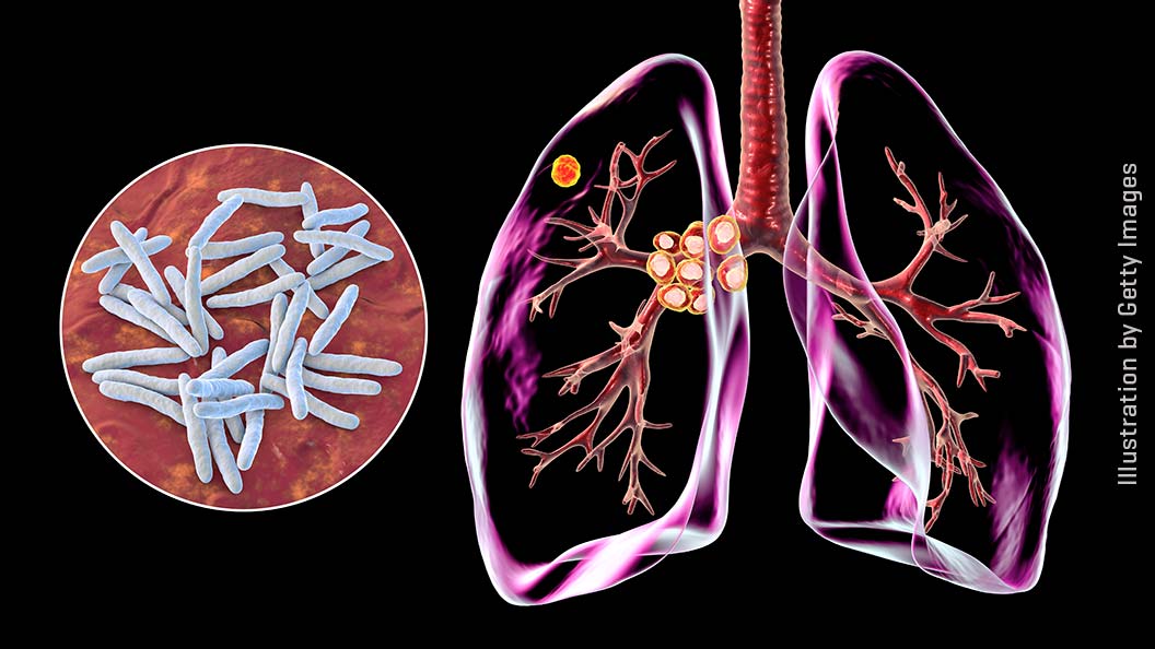 How Fred Hutch scientists tackle world’s top infectious killer, TB