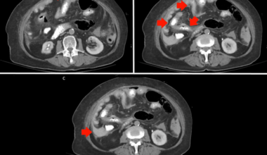 Recognizing Starvation Ketoacidosis in Acute Care Surgery: A Case Report and Literature Review