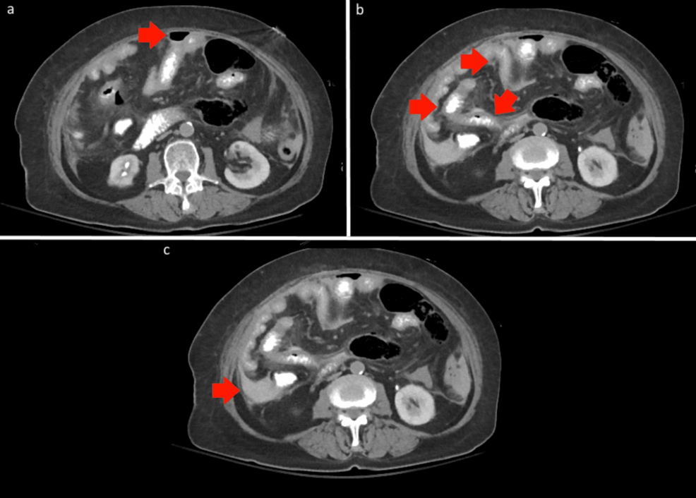 Recognizing Starvation Ketoacidosis in Acute Care Surgery: A Case Report and Literature Review