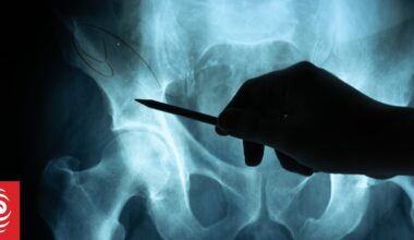 Health NZ discovers 180 radiology reports weren't sent back to doctors