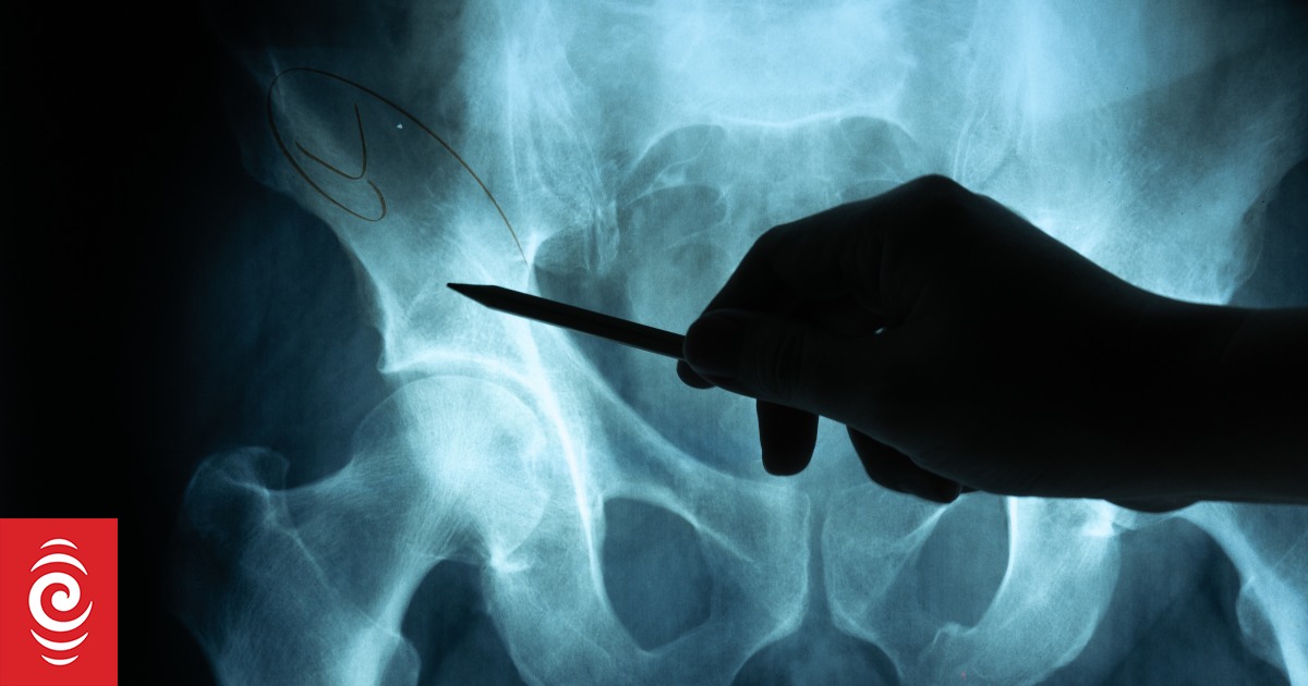 Health NZ discovers 180 radiology reports weren't sent back to doctors