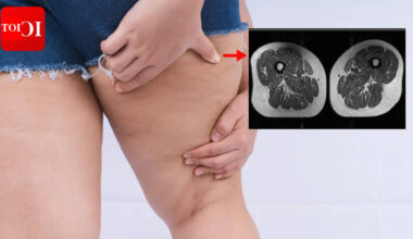 Ultra-Processed Foods: Ultra-processed foods linked to thigh fat accumulation and osteoarthritis |