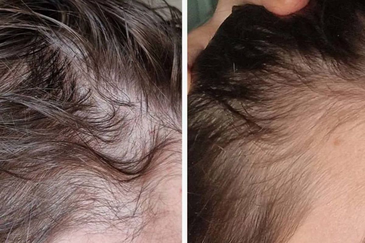 Two side-by-side images depicting the before and after effects of a hair treatment. The left image shows a region of thinning hair, while the right image exhibits a denser, healthier hair texture.