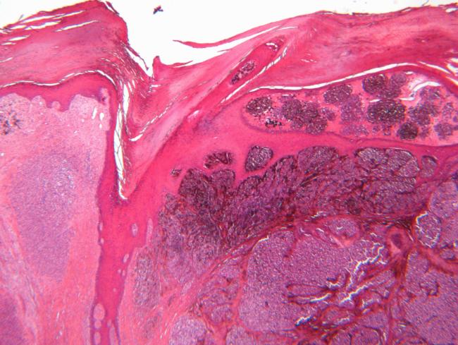 NIH-funded AI model predicts cancer survival from single-cell tumor data 