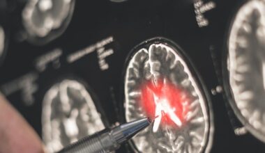 Natural compounds combined with antibodies show promise for safer Alzheimer's treatment