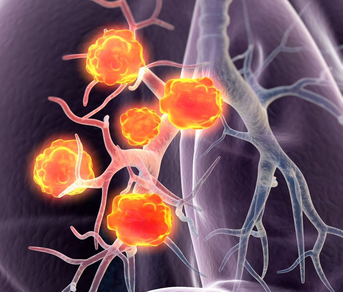 Addressing Unmet Needs in HER2+ Metastatic BTC