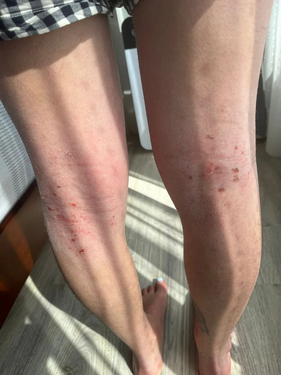 Rosemary's skin
