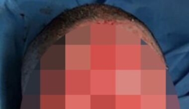 Panic as drug used by millions in the UK leaves woman with blisters and scarring on face | UK | News