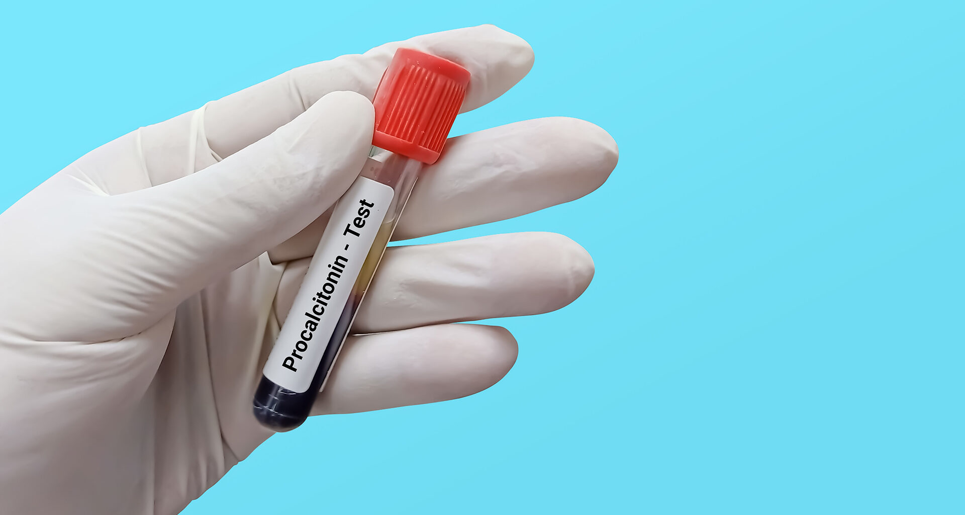 Early diagnostic test for sepsis