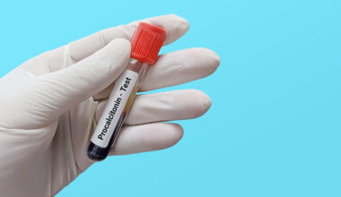 Early diagnostic test for sepsis